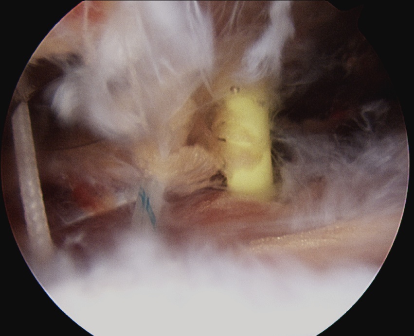 Subacromial sutures